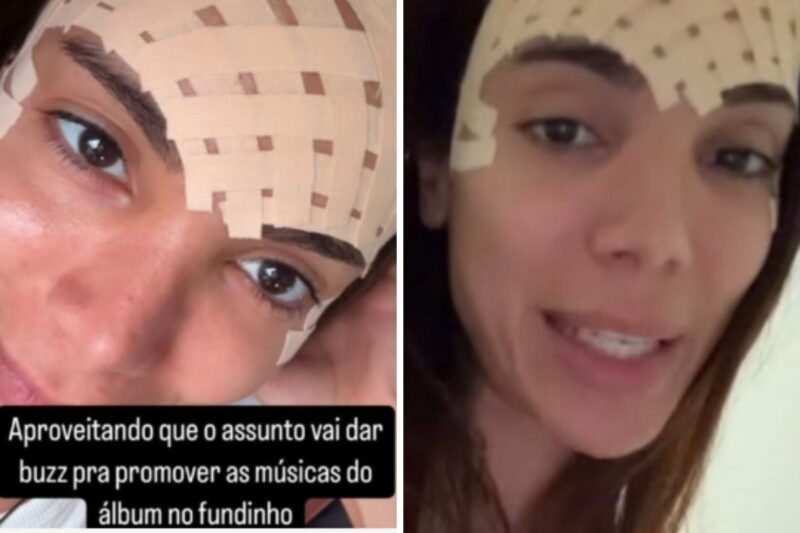 Saiba qual procedimento estético Anitta fez na testa