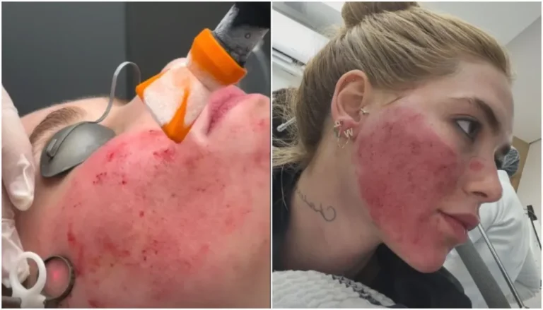 Virgínia Fonseca e seu rejuvenescimento facial